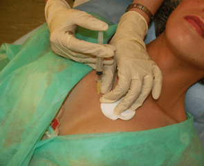 Einbringen eines Meso-Cocktails in das Brustgewebe, eine Alternative zu Hyaluronsäure-Injektionen