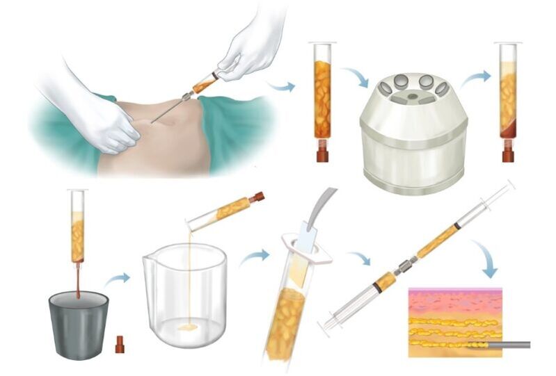 Entfernung von Fett aus Problemzonen, Verarbeitung und Injektion in das Brustgewebe.