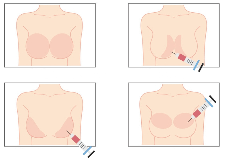 Stellen für die Injektion von Hyaluronsäure in der Brust.