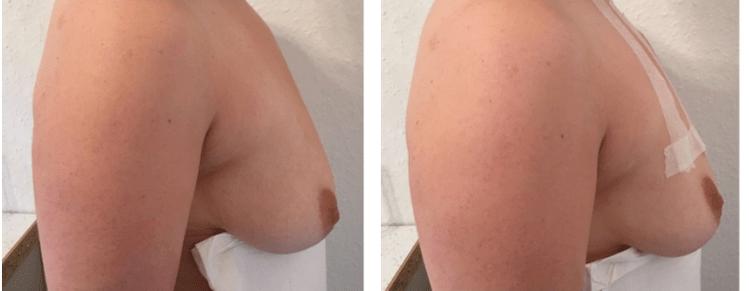 Vor und nach der Fadenbruststraffung