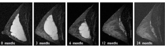 Der Prozess der Rückresorption von Hyaluronsäure in der Brust.